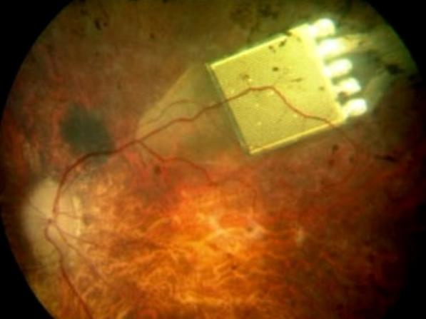 Oog-implantaat geeft blinden zicht terug